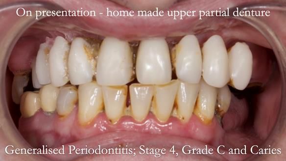 Newsletter 52 Managing Jo’s failing dentition with extractions and Mk 1/Mk 2 complete upper dentures and lower partial dentures FULL PROTOCOL