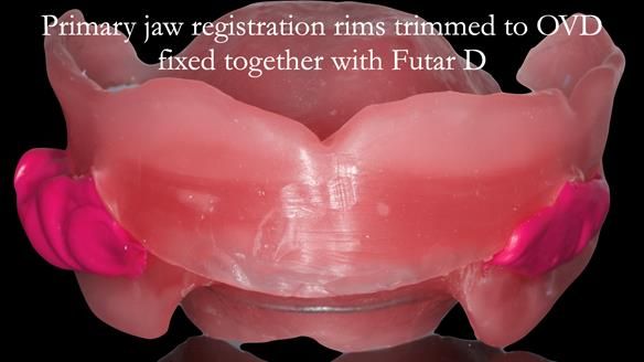 Newsletter 52 Managing Jo’s failing dentition with extractions and Mk 1/Mk 2 complete upper dentures and lower partial dentures FULL PROTOCOL