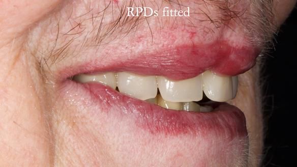 Newsletter 55 Provision of metal based partial dentures for Zephyrine with a repaired cleft lip and palate