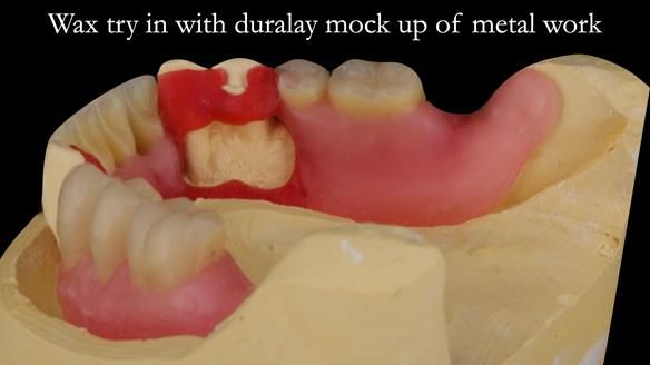 Finlay's Case Study Newsletter 40 - Immediate Mk 1 RPD to Definitive Mk 2 RPD - full protocol