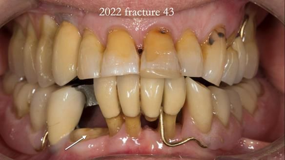 Ken – going downhill, first class