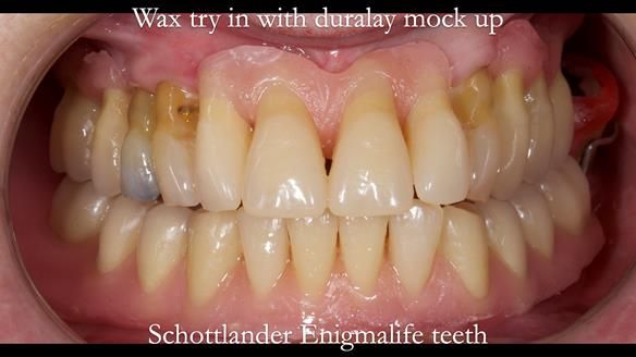 Finlay's Newsletter 59 Ultra hard partial dentures made for Gill