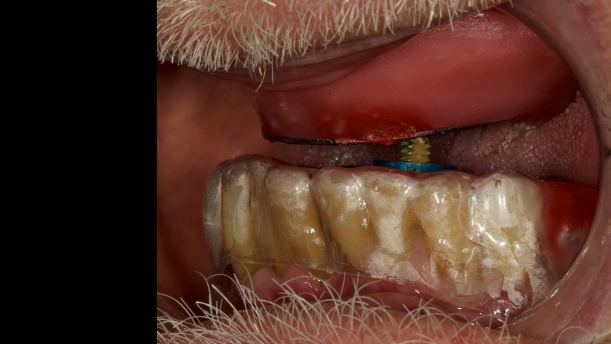 Newsletter 87 – Father Peter: A Partial Denture that needed Minor Miracle