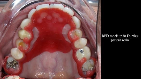 Newsletter 81 - Pam’s Story — how a partial denture changed her life (+ live walkthrough this Thursday)
