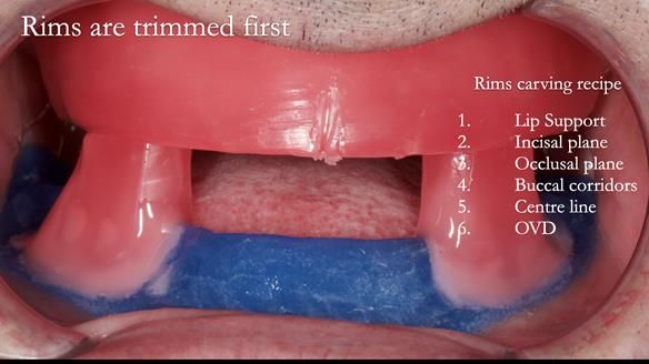 Newsletter 80 - Gordon’s dentures: the one case in 1,000 where my technique failed