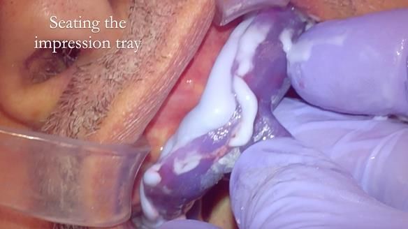 Finlay's Newsletter 62 provision of extractions and metal based complete dentures for Rafique