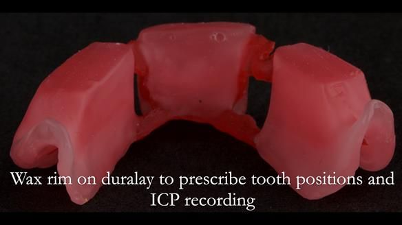 Finlay's Case Study Newsletter 40 - Immediate Mk 1 RPD to Definitive Mk 2 RPD - full protocol