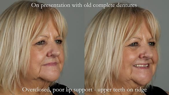 Newsletter 68 Restoring Jan’s Smile: Complete Dentures Inspired by Her Daughter’s Teeth - Post Mouth Surgery