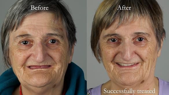 Newsletter 83: Sheila’s Complete Denture Success