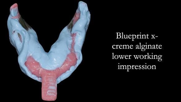 Newsletter 52 Managing Jo’s failing dentition with extractions and Mk 1/Mk 2 complete upper dentures and lower partial dentures FULL PROTOCOL