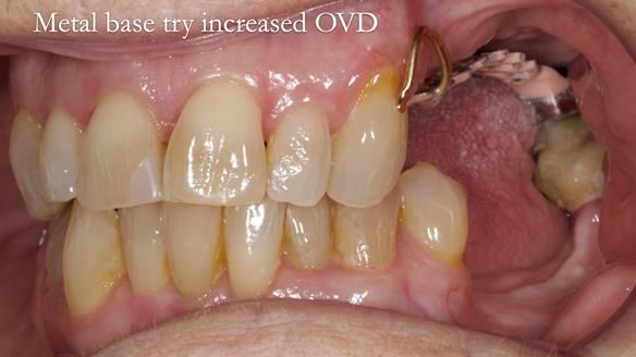 Finlay's Newsletter 60 Sylvia's upper Kennedy Class 2 Mod 1 metal based upper RPD