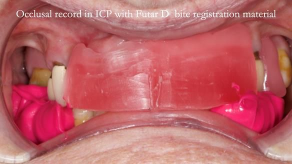 Eileen's transformation with upper and lower RPDs of Scandinavian hygienic design FULL PROTOCOL