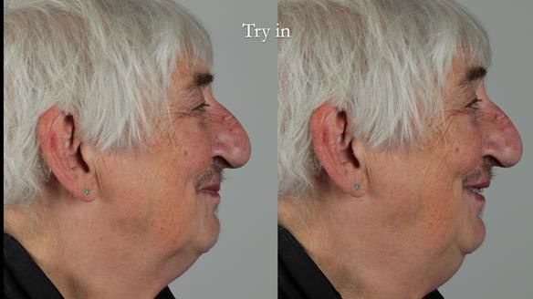 Newsletter 55 Provision of metal based partial dentures for Zephyrine with a repaired cleft lip and palate