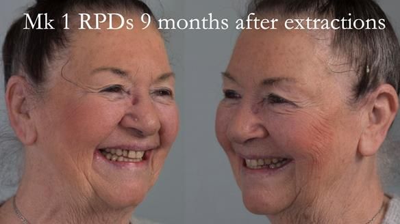 Finlay's Case Study Newsletter 40 - Immediate Mk 1 RPD to Definitive Mk 2 RPD - full protocol