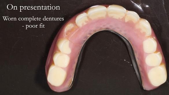 Newsletter 57 showcases the making and fitting process of implant-supported complete dentures for Alisdair