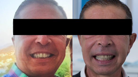 Figure 49 Visit 3 Review 1 post extraction of Mk 1 upper complete and lower partial immediate dentures