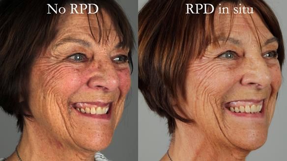 Finlay's Newsletter 61 provision of a lower unilateral free end saddle metal based partial denture for Joyce