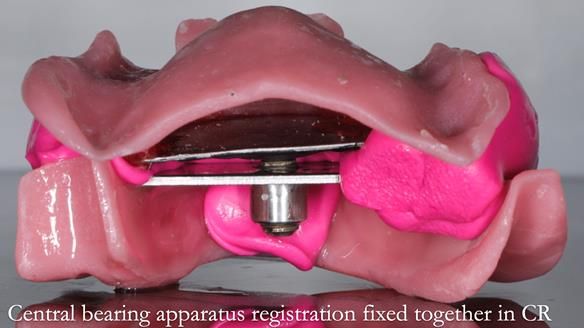 Finlay's Newsletter 59 Ultra hard partial dentures made for Gill