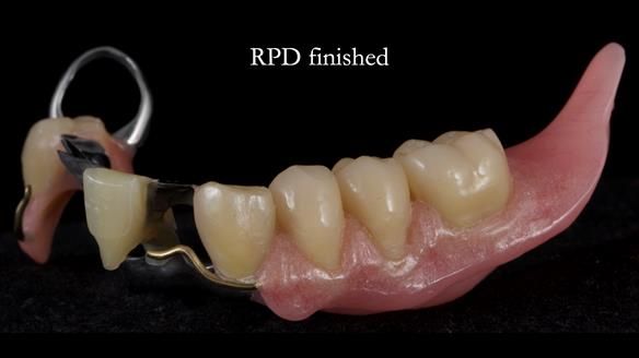 Newsletter 55 Provision of metal based partial dentures for Zephyrine with a repaired cleft lip and palate