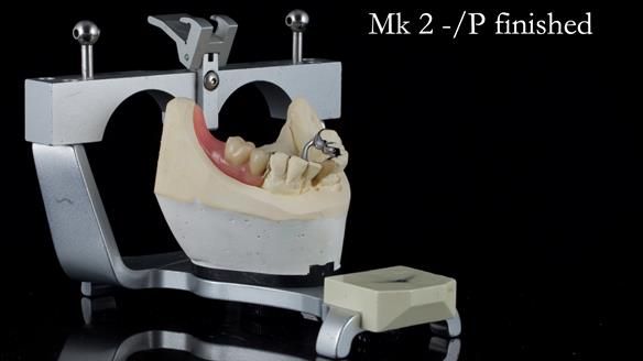Newsletter 54 case presentation upper complete denture and lower Scandinavian designed hygienic partial denture for David