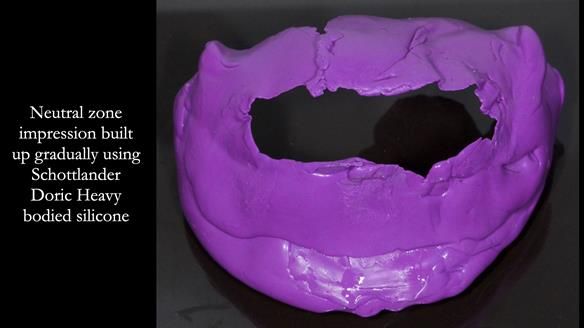 Newsletter 83: Sheila’s Complete Denture Success