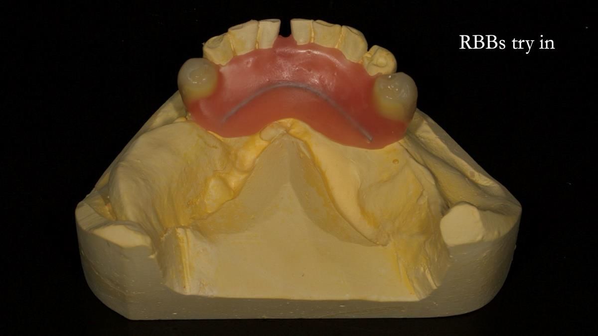 Newsletter 87 – Father Peter: A Partial Denture that needed Minor Miracle