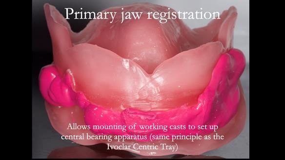 Finlay's Newsletter 62 provision of extractions and metal based complete dentures for Rafique