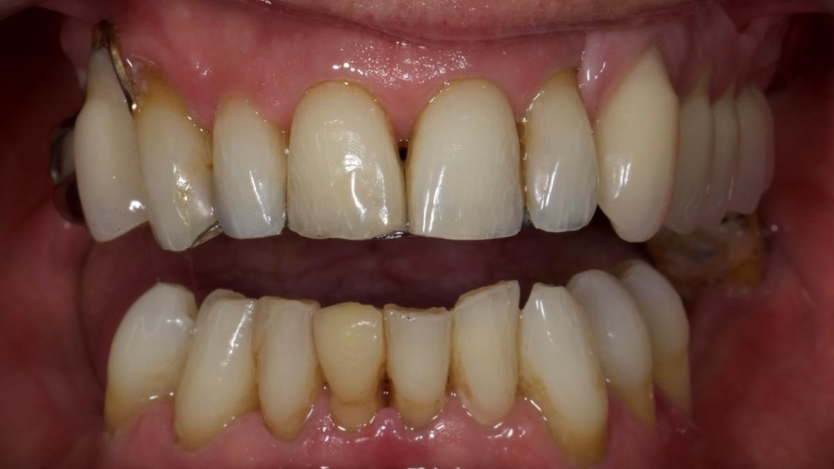 Newsletter 89 – Simon: A Challenging Kennedy Class II Division 1 Upper CoCr Partial Denture with a High Smile Line