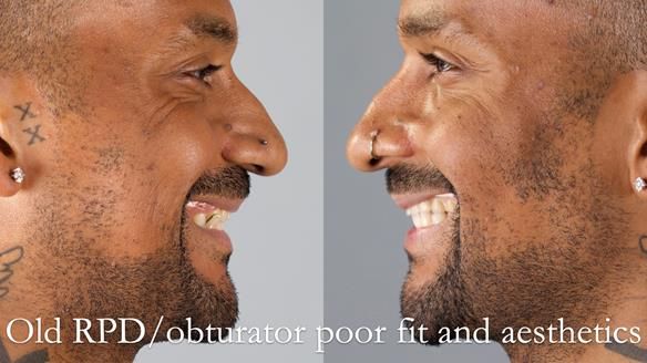 Acrylic based partial denture/obturator had poor, retention and support Obturator section was in poor condition. The Adams clasp were causing inflammation of the gingival margins. The clasp on the UR3 was visible resulting in poor appearance. Reduced lip