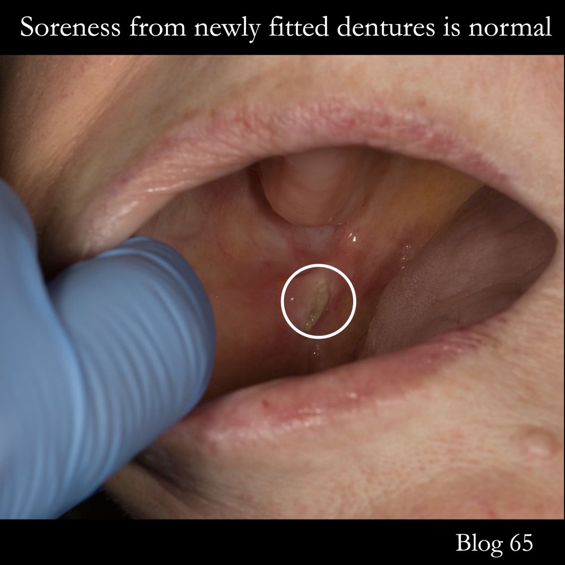 Newly fitted dentures will become sore