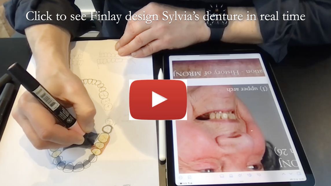 Finlay designs a Kennedy class 2 (1) metal based partial denture for Sylvia - who has had MRONJ - VIDEO ON YouTube