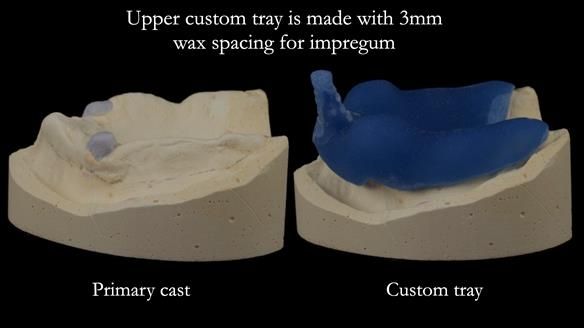 Newsletter 57 showcases the making and fitting process of implant-supported complete dentures for Alisdair