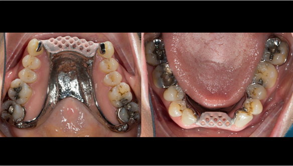  Figure 70 Cobalt chromium framework trial insertion, checking the fit onto the natural teeth