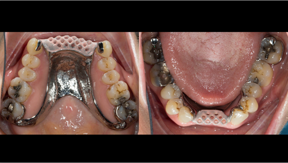 Figure 70 Cobalt chromium framework trial insertion, checking the fit onto the natural teeth