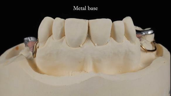 Finlay's Newsletter 60 Sylvia's upper Kennedy Class 2 Mod 1 metal based upper RPD