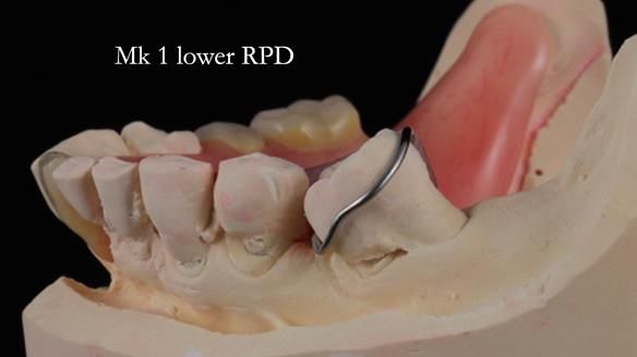 Newsletter 54 case presentation upper complete denture and lower Scandinavian designed hygienic partial denture for David