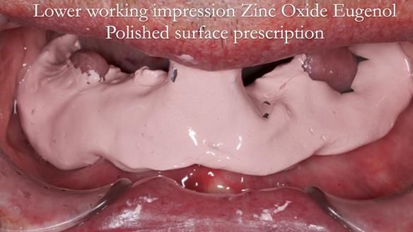 Newsletter 75: Marion’s case - Step-by-step complete denture workflow