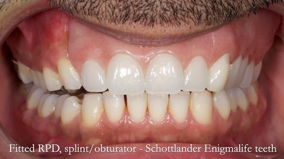 Upper metal base partial denture/occlusal stabilisation splint/obturator - full protocol