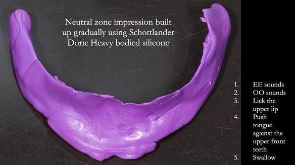Newsletter 83: Sheila’s Complete Denture Success