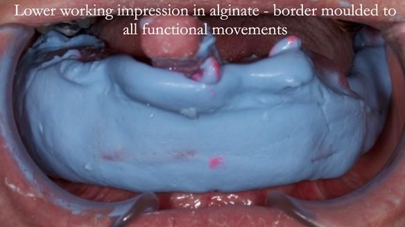 Newsletter 52 Managing Jo’s failing dentition with extractions and Mk 1/Mk 2 complete upper dentures and lower partial dentures FULL PROTOCOL