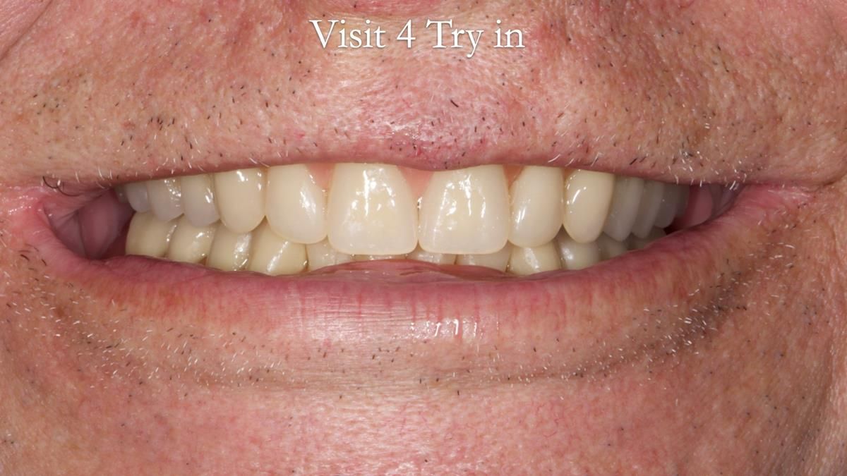 Fin’s Newsletter 88 — Complete dentures - full protocol… he rearranged his own teeth!