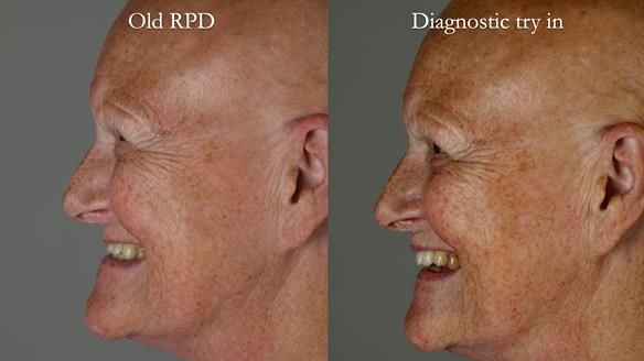 Newsletter 81 - Pam’s Story — how a partial denture changed her life (+ live walkthrough this Thursday)