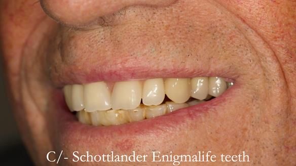Newsletter 54 case presentation upper complete denture and lower Scandinavian designed hygienic partial denture for David