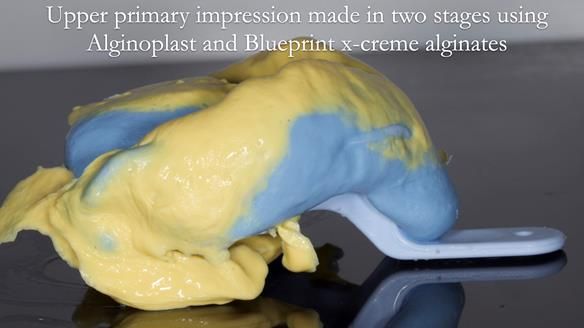 Newsletter 57 showcases the making and fitting process of implant-supported complete dentures for Alisdair