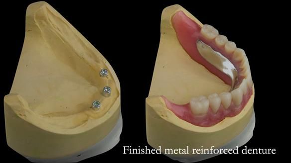 Finished metal reinforced lower denture finished to the land area of the model for optimal polished surfaces