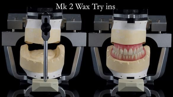 Replacing Madeline’s Complete denture FULL PROTOCOL
