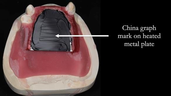 Finlay's Newsletter 59 Ultra hard partial dentures made for Gill
