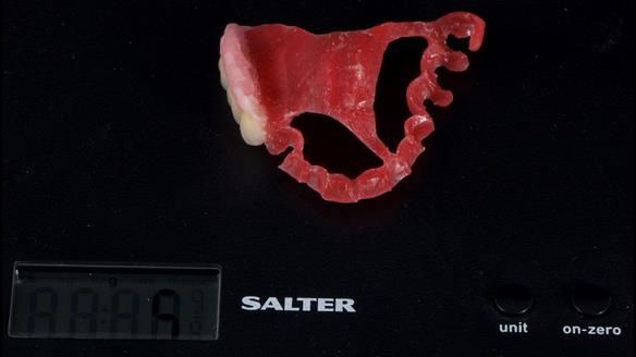 Finlay's Newsletter 64 case study - provision of a Kennedy class 2 metal based Scandinavian RPD for Ian