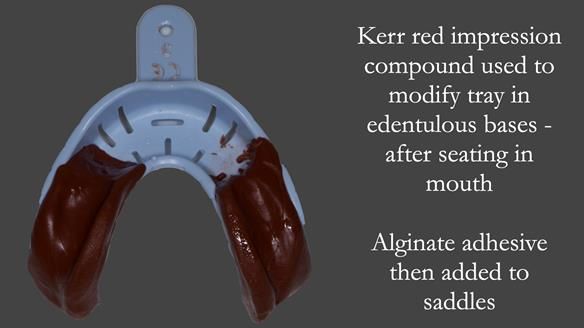 Newsletter 52 Managing Jo’s failing dentition with extractions and Mk 1/Mk 2 complete upper dentures and lower partial dentures FULL PROTOCOL