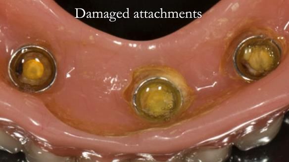 Denture not seating properly on the implants - damaging the Locator inserts. I decided to remove the housings and cold cure in new housings to improve the fit for Mary temporarily